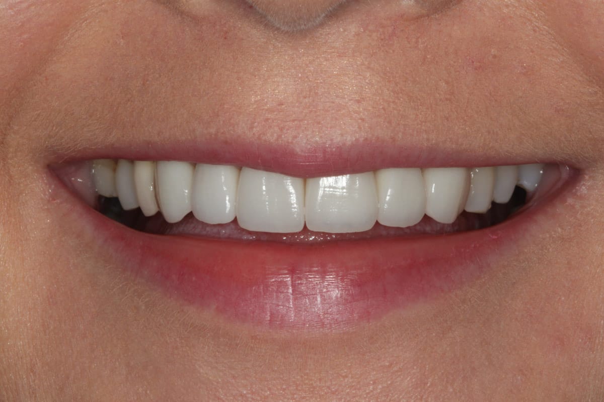 Smile design - COSTA RICA DENTAL SERVICES